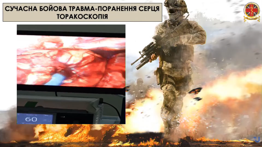 Фрагмент з операції на сердці з використанням тораскопії. Стоп-кадр з відео Укрінформ