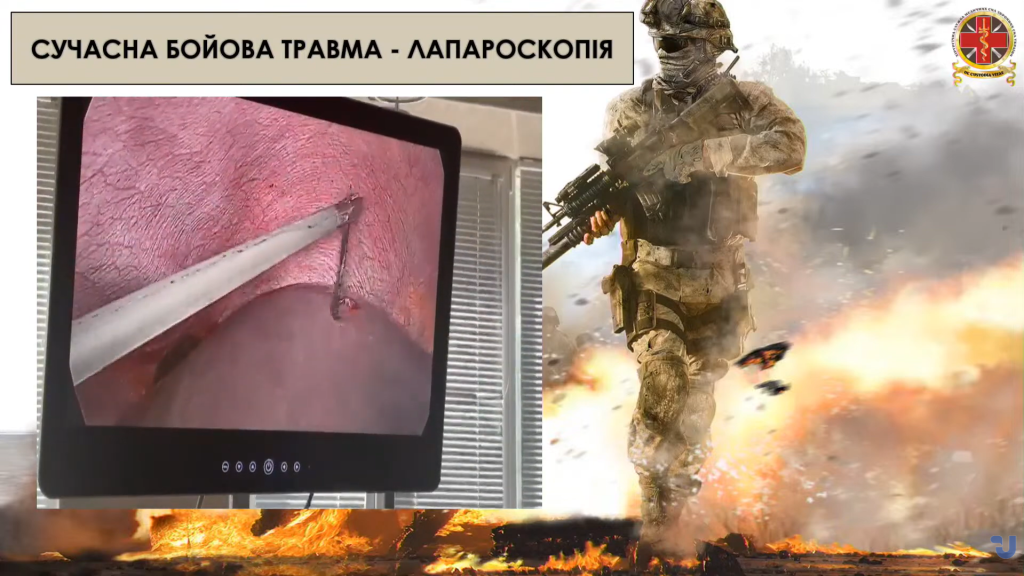 Фрагмент з операції видаленя флешети з печінки з використанням лапароскопії. Стоп-кадр з відео Укрінформ