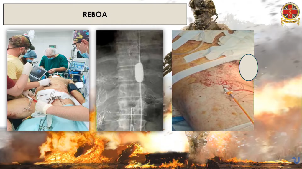 Використання системи REBOA. Стоп-кадр з відео Укрінформ