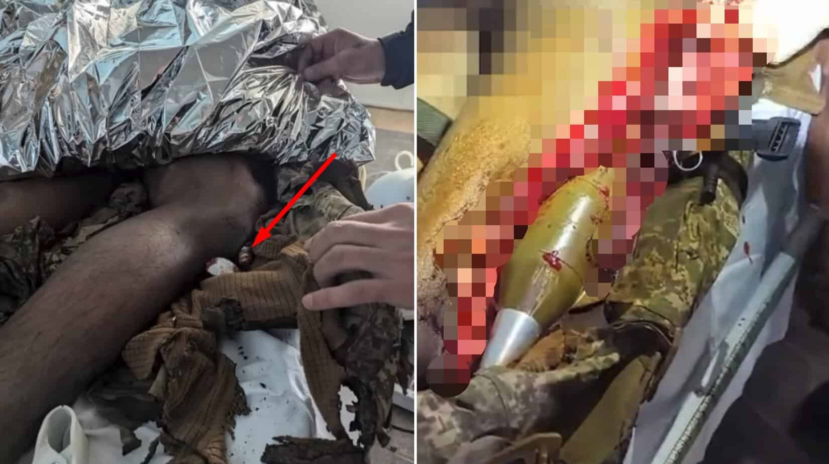 Doctors Removed Shell from Leg of Wounded Soldier