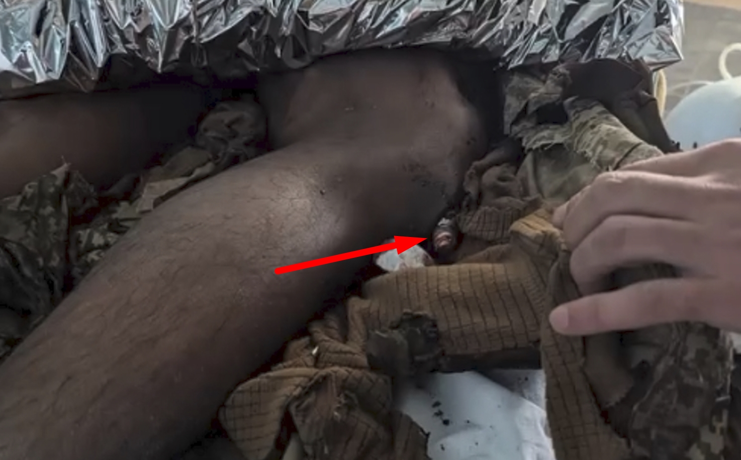 Initial examination of the wounded Ukrainian soldier with a shell in his leg. April 2026. Photo credits: Second Medical Battalion