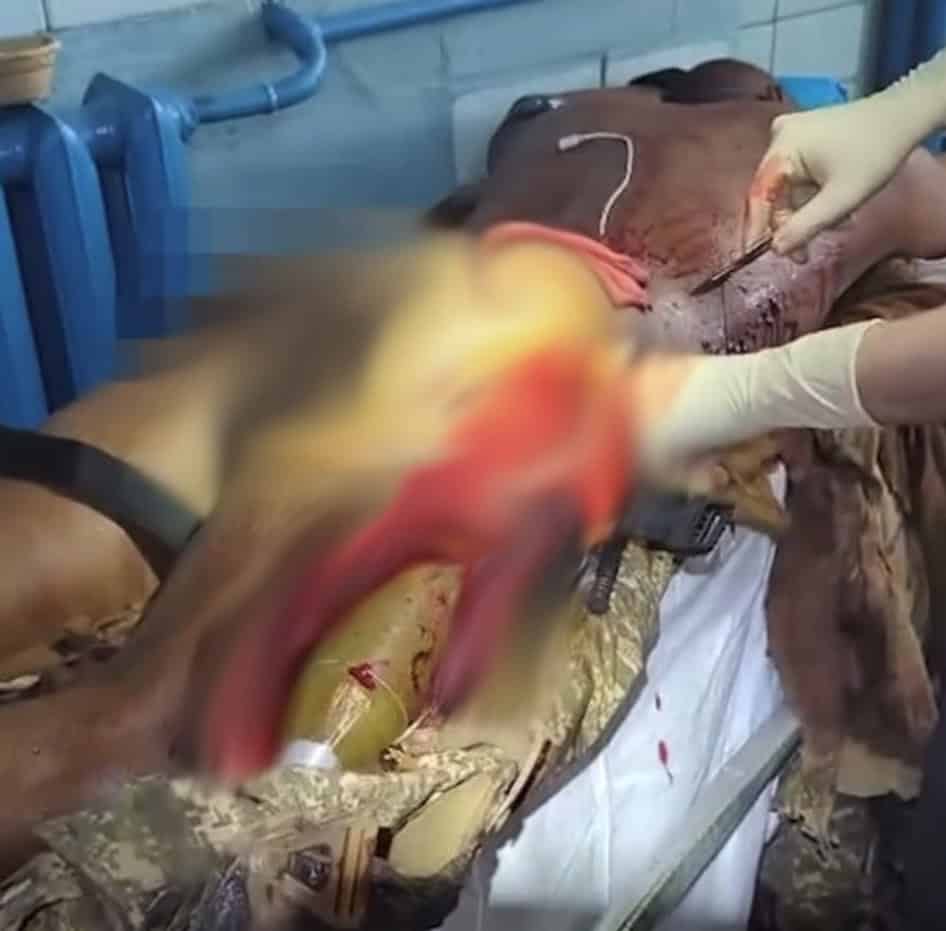 Surgery to remove the projectile from the wounded soldier’s leg. April 2026. Photo credits: Second Medical Battalion